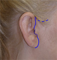 mini face lift incision